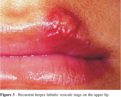 herpes pictures. a quot;recurrentquot; Herpes sore