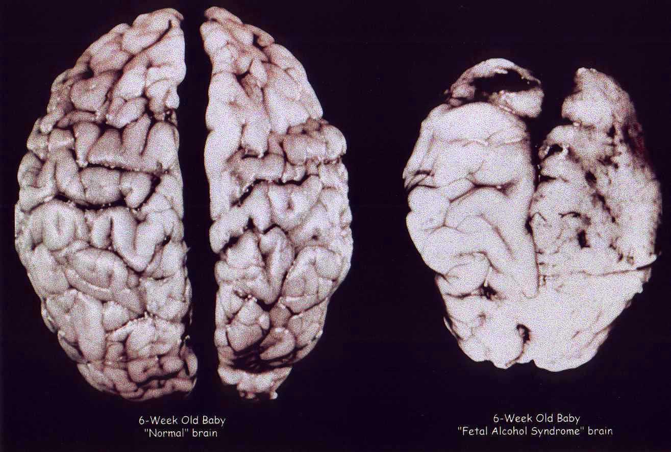 Необратимые нарушения головного мозга. Алкогольная энцефалопатия патологическая анатомия. Мозг человека алкоголика.
